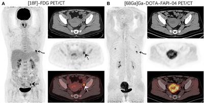 68Ga-DOTA-FAPI-04 PET/CT as a Promising Tool for Differentiating Ovarian Physiological Uptake: Preliminary Experience of Comparative Analysis With 18F-FDG